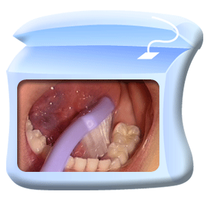 图中所见是用牙刷清洁臼齿的内侧面。