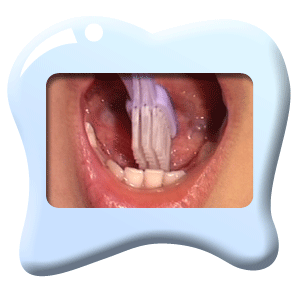 Photograph showing the inner surfaces of incisors being cleaned with a toothbrush.