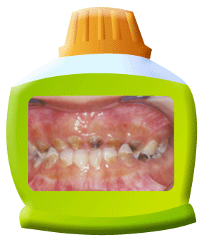圖中所見是上下排牙齒，前牙和後牙都患有幼兒嚴重蛀牙。