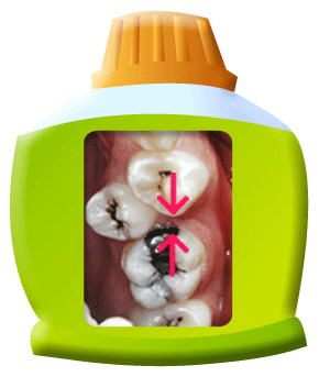 圖中所見是乳齒給過早拔除後，鄰近的牙齒移向原先預留給繼承恆齒的缺牙空隙，致使繼承恆齒要在正常牙列之外長出。