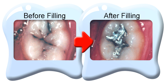 Photograph of the appearance of a decayed tooth before and after an amalgam is placed.