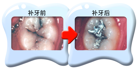 图中所见是蛀坏的牙齿以汞合金填补之前和之后的外貌。