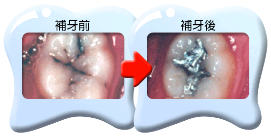 圖中所見是蛀壞的牙齒以汞合金填補之前和之後的外貌。