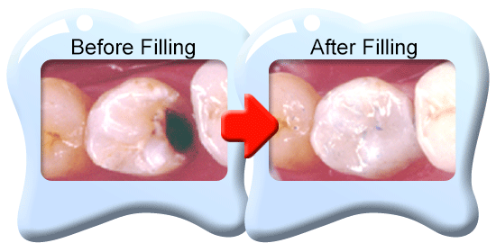 Photograph of the appearance of a decayed tooth before and after filling with composite.