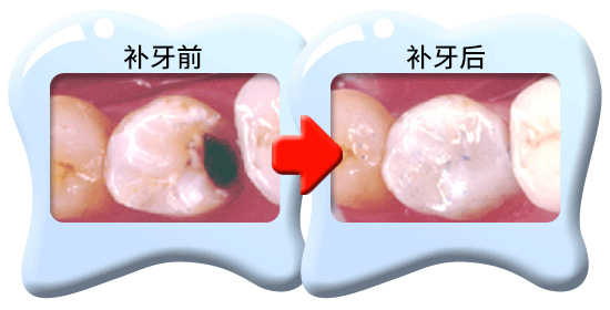 图中所见是蛀坏的牙齿以复合树脂填补之前和之后的外貌。