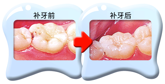 图中所见是蛀坏的乳齿以玻璃离子水门汀修补之前和之后的外貌。