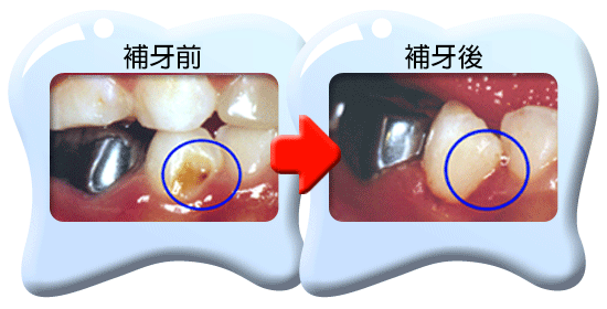 圖中所見是乳齒原本蛀壞的部分以玻璃離子樹脂填補後的外貌。