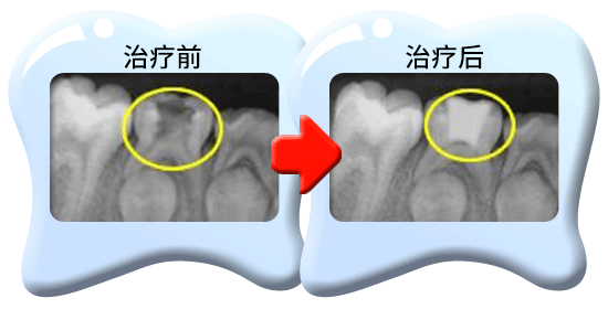 图中所见是两张X光片，显示一颗接受清除部分牙髓的治疗的乳臼齿，分别是治疗前和治疗后的情况。