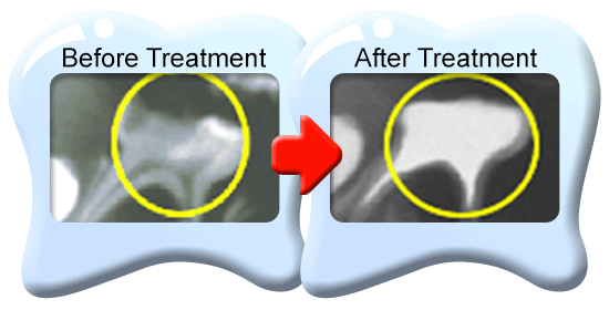 Photograph of two x-ray films showing a deciduous molar with total removal of pulp tissues before and after treatment.