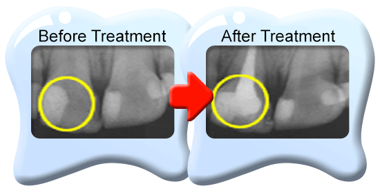 Photograph of two x-ray films showing a permanent tooth with total removal of pulp tissues before and after treatments.
