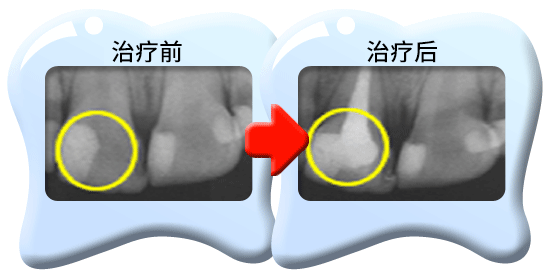 图中所见是两张X光片，显示一颗接受清除全部牙髓的治疗的恒齿，分别是治疗前和治疗后的情况。