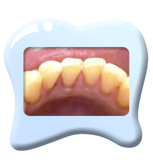 Photograph of  the clean lower front teeth after scaling.