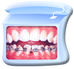 Photograph of front teeth showing that the orthodontic wire and brackets are connected by elastics and stainless steel wire.