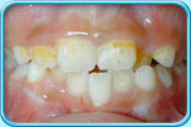 Photograph of front teeth with orange stains.