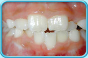 Photograph of front teeth after removal of orange stains.