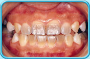 Photograph of front teeth having greyish-blue to brownish-yellow stains.