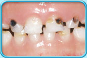 Photograph of a set of deciduous front teeth some of them show black tooth decay.