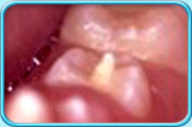 Photograph of a Leong's premolar.