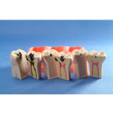 The process of Dental Caries