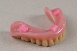Photograph of a lower denture with a few dots of  denture adhesive on its fitting surface.