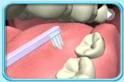 Animation showing the cleaning of wisdom tooth with a single-tuft toothbrush.