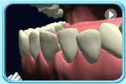 动画所见是以单头牙刷清洁排列不整齐的牙齿。