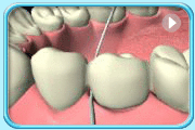 動畫所見是把特效牙線的纖維部分分別緊貼牙橋底部和牙齦並來回拉動的情況。