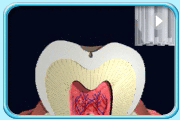 動畫所見是一顆牙齒的縱切面，可見位於牙冠的紋溝既深且窄。