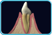 图中所见是一颗牙齿及其周边组织的纵切面，并显示牙龈边缘与牙齿之间的龈沟内积藏着牙菌膜。