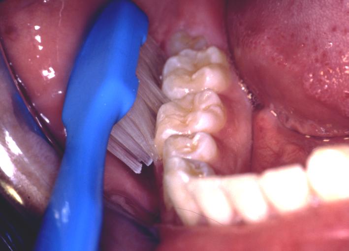 Photograph of a toothbrush brushing the outer surfaces of lower teeth.