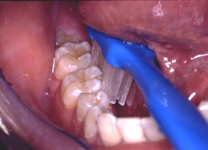 Photograph of a toothbrush brushing the inner surfaces of lower teeth.