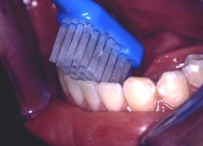 Photograph of a toothbrush brushing the inner surfaces of lower incisors.