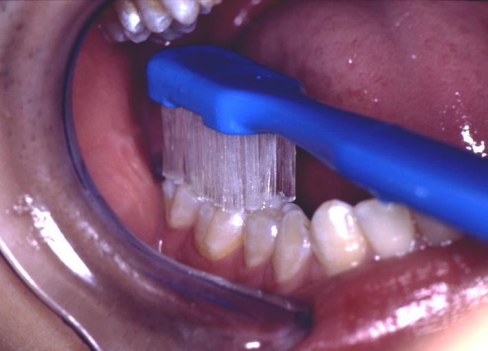 Photograph of a toothbrush brushing the chewing surfaces of lower teeth.