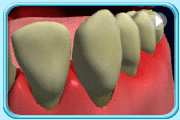 動畫所見是以牙周探針探進牙周袋內，檢視牙周袋的深度。