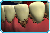 图中所见是有牙石积聚的牙齿。