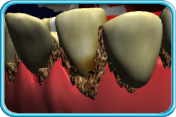 Photograph of a set of irregular teeth.