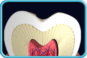 Photograph of the longitudinal section of a tooth crown showing initial decay.