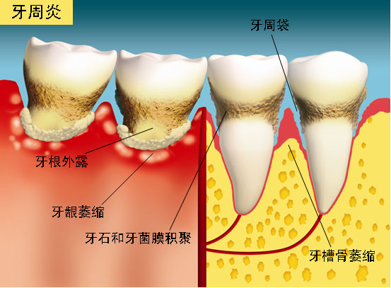 图中所见是患有牙周炎的情况，徵状包括牙根外露、牙齦和牙槽骨萎缩、牙石和牙菌膜积聚，并有牙周袋。