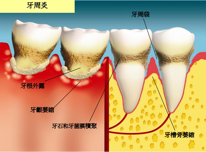 圖中所見是患有牙周炎的情況，徵狀包括牙根外露、牙齦和牙槽骨萎縮、牙石和牙菌膜積聚，並有牙周袋。