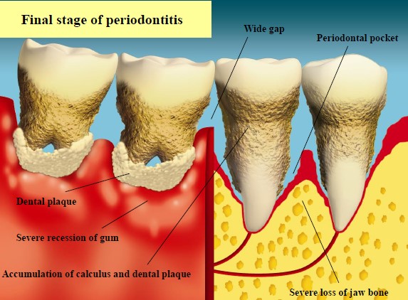 Photograph shows the final stage of periodontitis. Its symptoms include severe recession of gum and bone, the accumulation of calculs and plaque, wide interdental gap and the presence of periodontal pocket.