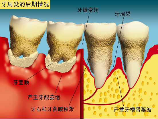 图中所见是患有牙周炎的后期情况，徵状包括牙齦和牙槽骨严重萎缩、牙石和牙菌膜积聚，牙缝变阔，并有牙周袋。