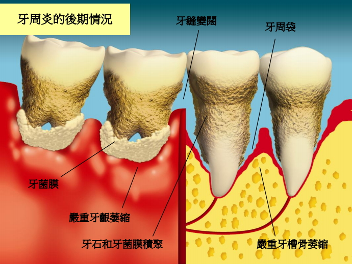圖中所見是患有牙周炎的後期情況，徵狀包括牙齦和牙槽骨嚴重萎縮、牙石和牙菌膜積聚，牙縫變闊，並有牙周袋。