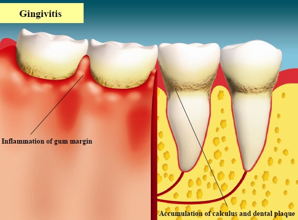Photograph shows the condition of gingivitis. Its symptoms include inflammation of gum margin and the accumulation of calculus and dental plaque on the tooth surface.
