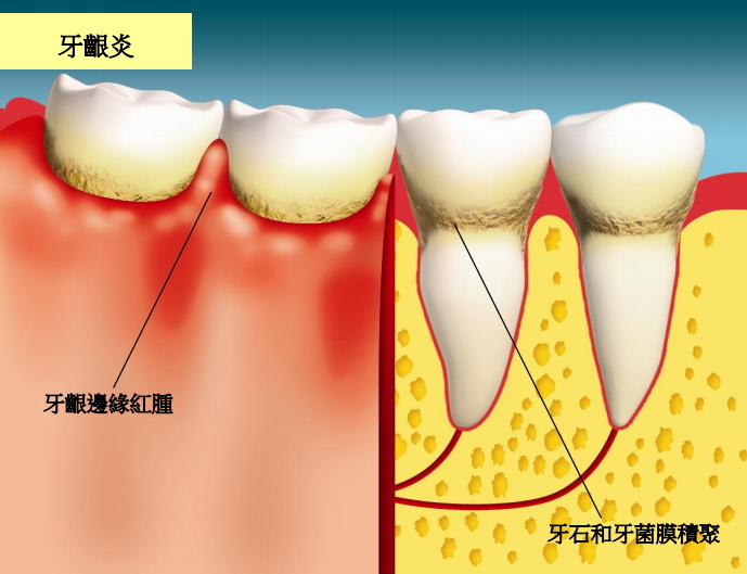 圖中所見是患有牙齦炎的情況，徵狀包括牙齦邊緣紅腫、牙齒表面有牙石和牙菌膜積聚。