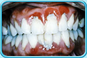 Photograph of a set of teeth, with red and swollen gums on the front teeth and the accumulation of dental plaque and calculus along the gum margin.