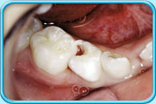 图中所见是右下几颗乳齿，其中一颗牙齿有一个明显的蛀洞。