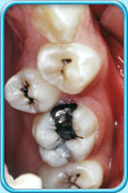 Photograph showing a poor alignment of teeth after drifting of neighbouring teeth.