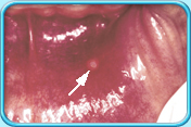 图中所见是以箭头指示口腔里唇部的痱滋所在位置，痱滋呈圆形的小泡。