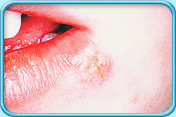 图中所见是下唇近嘴角位置有明显唇疮。