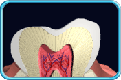 Photograph of the longitudinal section of a tooth showing with exposed dentine.